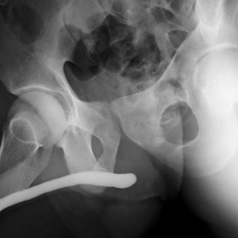 Retrograde Urethrogram: Symptoms, Diagnosis & Treatment